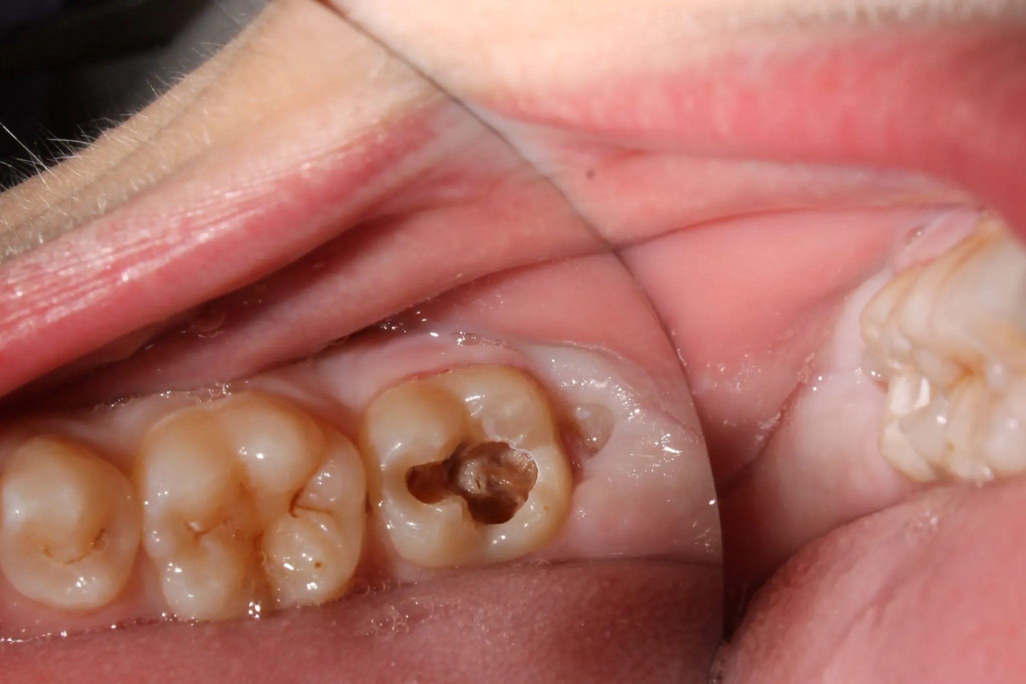 Caries dental: causas, cómo prevenirla y qué remedios caseros pueden aliviar sus síntomas